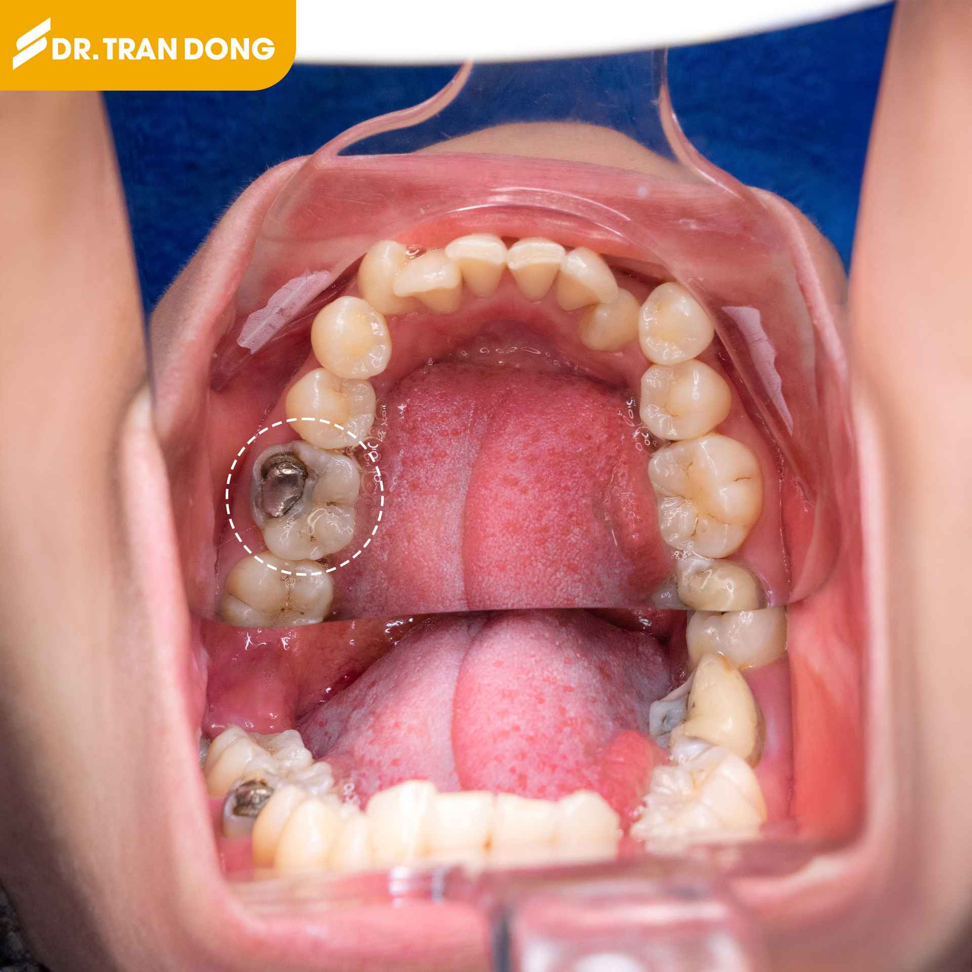 Trước trám răng sâu